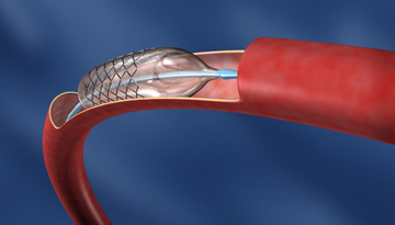 Research of the Russian market of intravascular prostheses (stents)